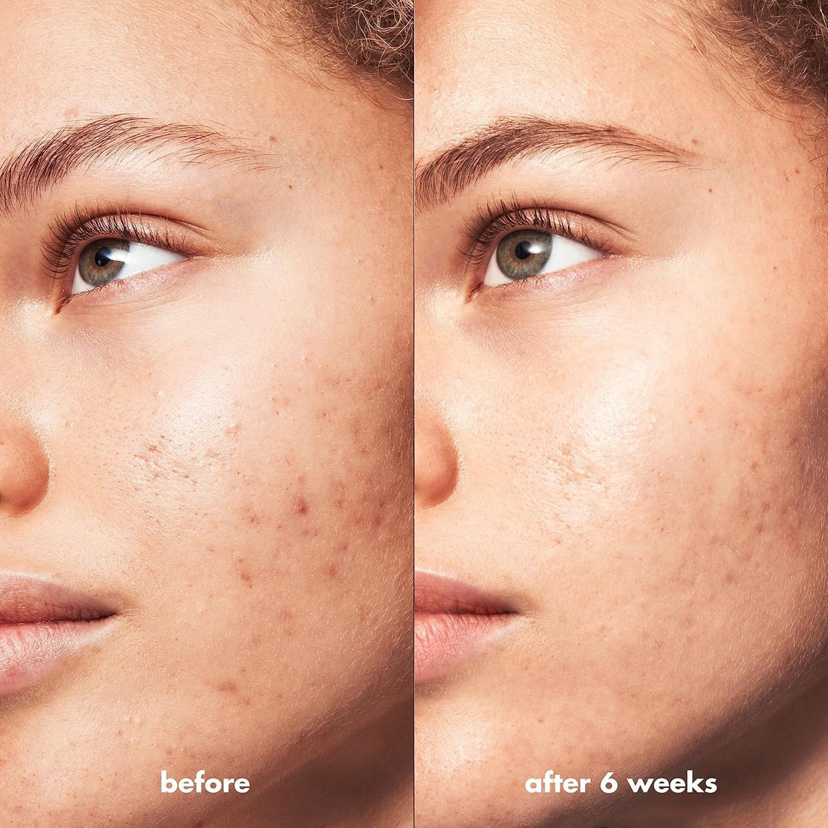 elf Blemish Breakthrough Triple-Acid Resurfacing Serum
