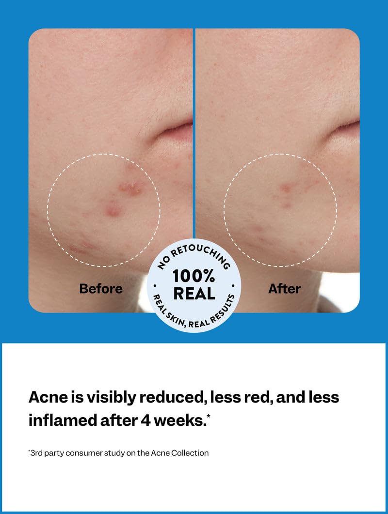 3-Step Acne Starter Kit