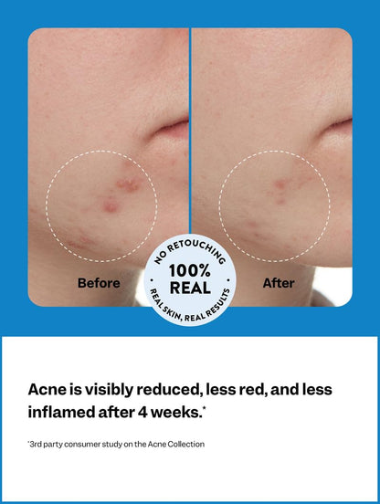 3-Step Acne Starter Kit