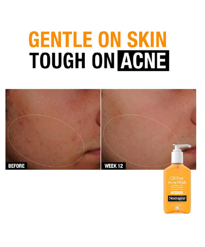 Oil-Free Acne Wash