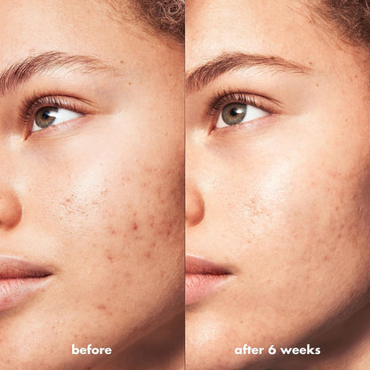 elf Blemish Breakthrough Triple-Acid Resurfacing Serum